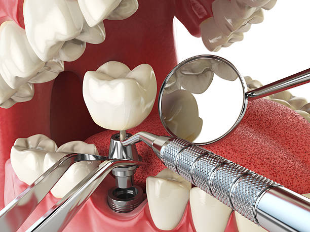 Best Emergency Dental Care for Broken or Chipped Teeth in Stratford Downtown, CT